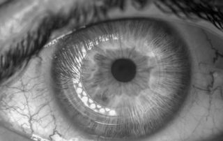 Pupilas puntiformes: causas, síntomas y tratamientos