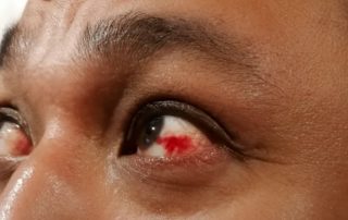 ¿Qué hacer si tengo un derrame o una hemorragia en el ojo?