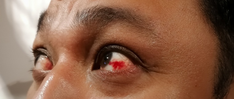 ¿Qué hacer si tengo un derrame o una hemorragia en el ojo?